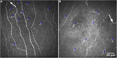 Defining an Optimal Sample Size for Corneal Epithelial Immune Cell Analysis Using in vivo Confocal <mark class="highlighted">Microscopy Images</mark>